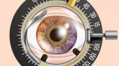 How many appointments / visits is cataract surgery?